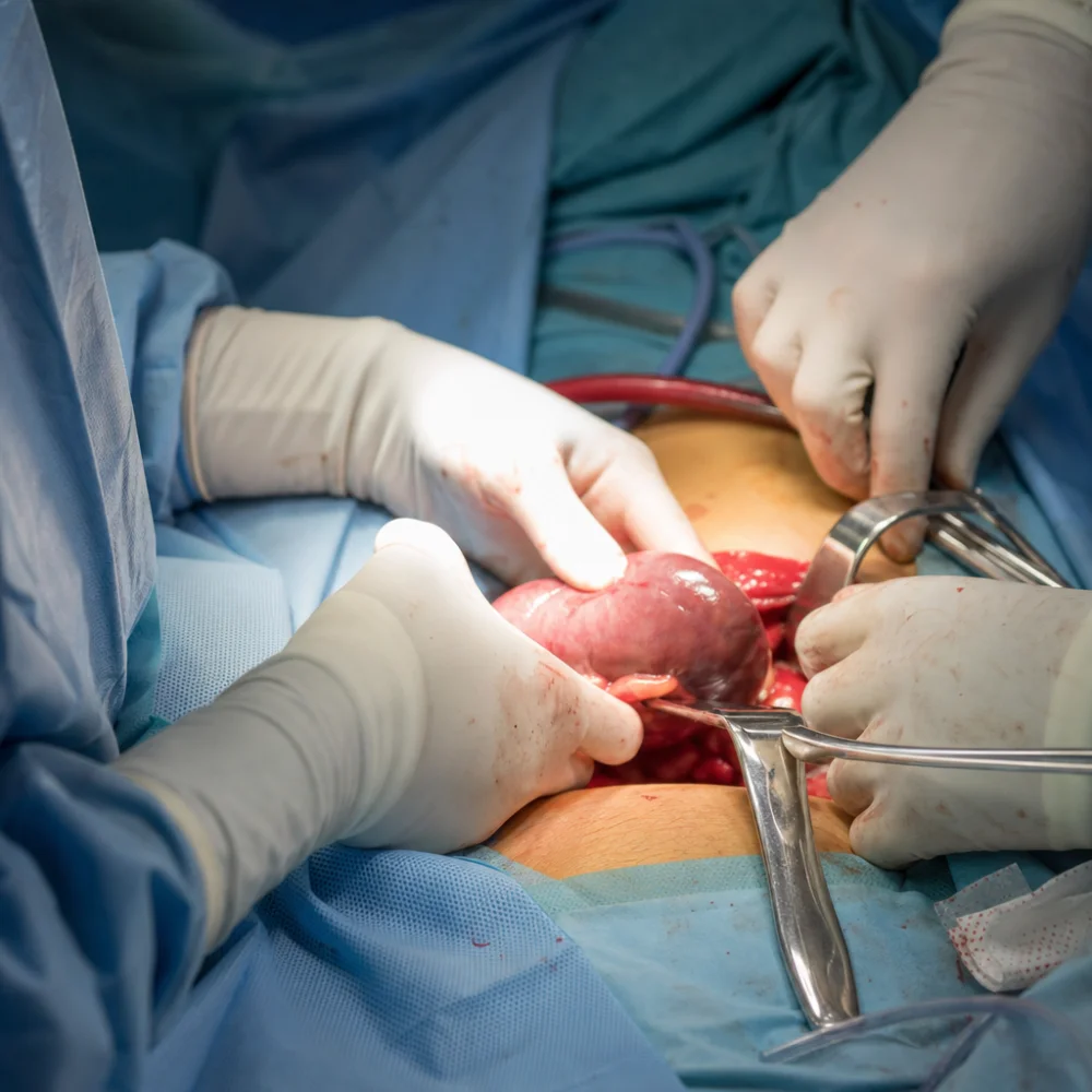 Pacienti S Transplantovanou Prasečí Ledvinou Přešli Na Lidský Orgán Po Roce Bez Dialýzy